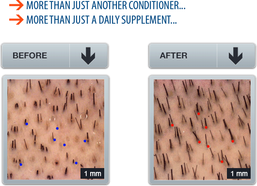 Profollica Before After